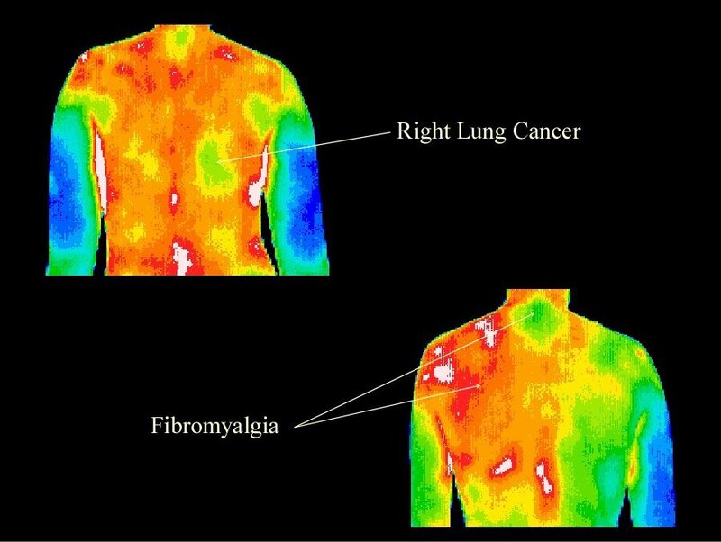 Right Lung Cancer