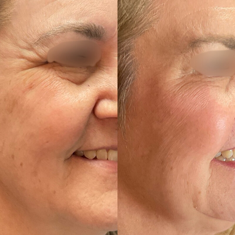 Before and after photos of Zula Modern Medspa wrinkle and fine line treatment patient
