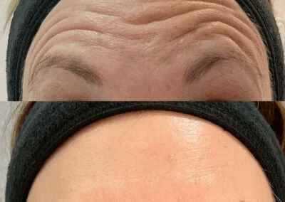 Botox.-Lines-on-forehead-before-and-after-400x284
