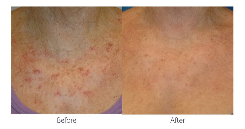 Before and after photos of Zula Modern Medspa hyperpigmentation treatment patient