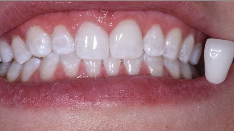 Example 2-After getting the Zoom Whitening treatment