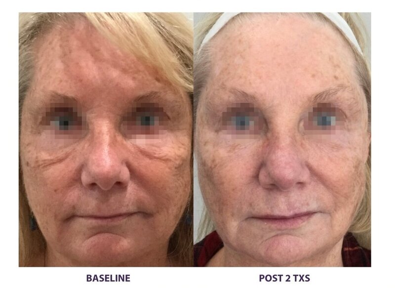 Before and after photos of Zula Modern Medspa pore texture treatment patient