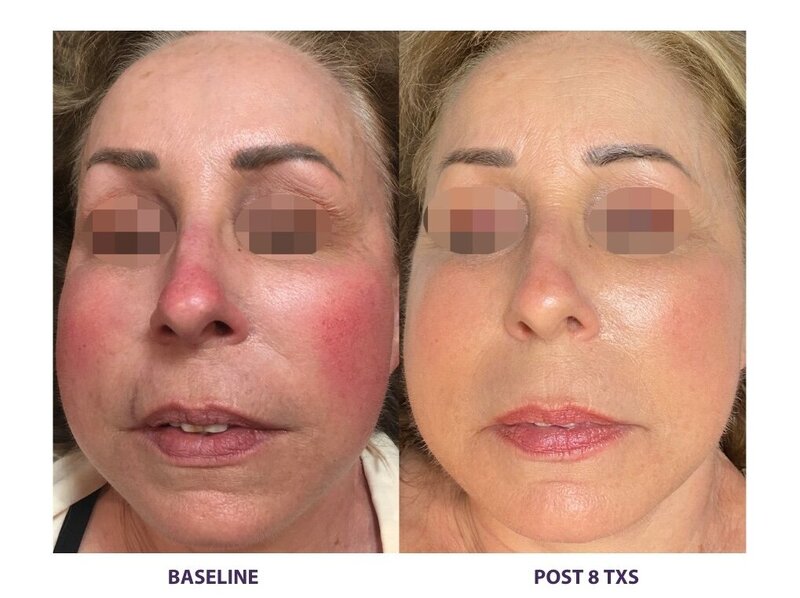 Before and after photos of Zula Modern Medspa rosacea treatment patient