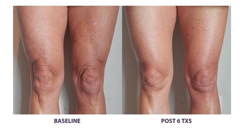 Before and after photos of Zula Modern Medspa fat loss treatment patient