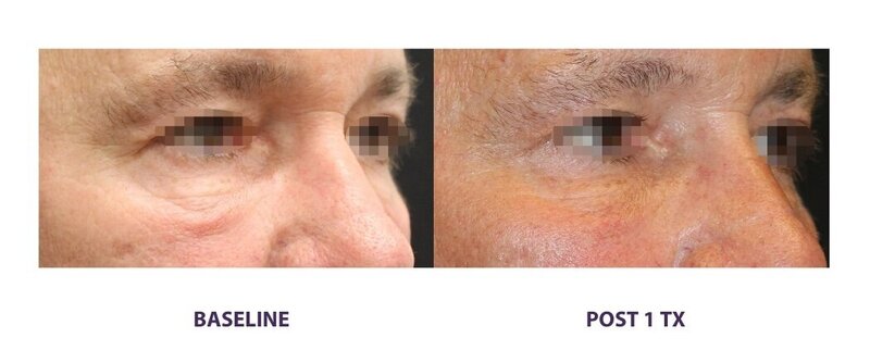Before and after photos of Zula Modern Medspa wrinkle and fine line treatment patient