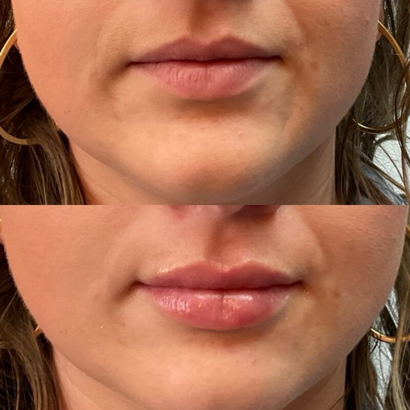 Before and after photos of Zula Modern Medspa volume loss treatment patient