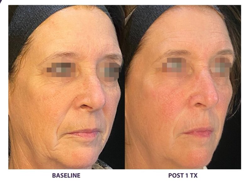 Before and after photos of Zula Modern Medspa double chin treatment patient