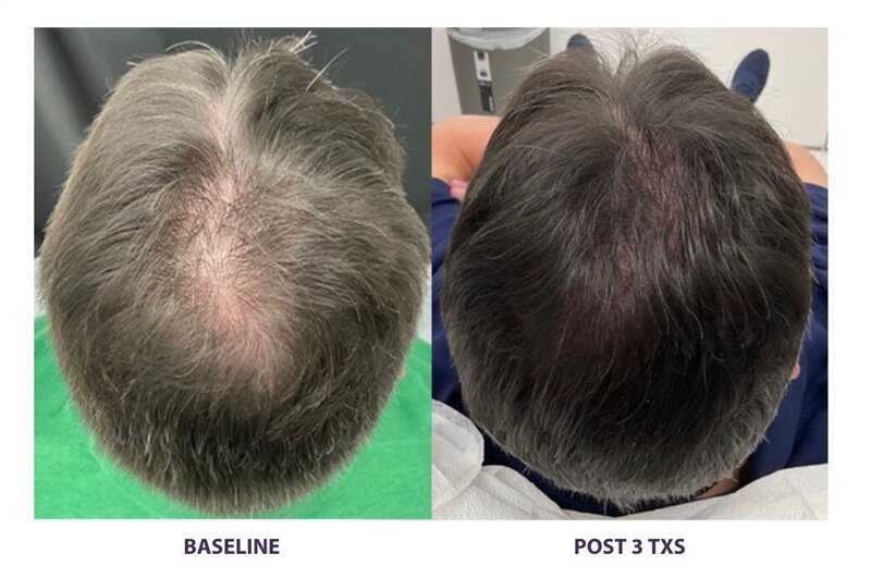 Before and after photos of Zula Modern Medspa hair thinning treatment patient