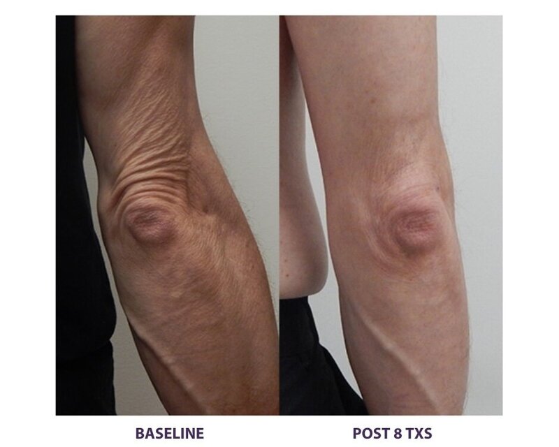 Before and after photos of Zula Modern Medspa anti-aging treatment patient