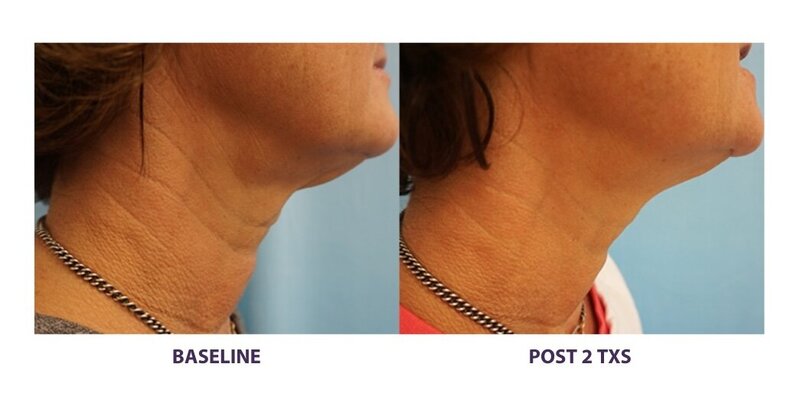 Before and after photos of Zula Modern Medspa wrinkle and fine line treatment patient