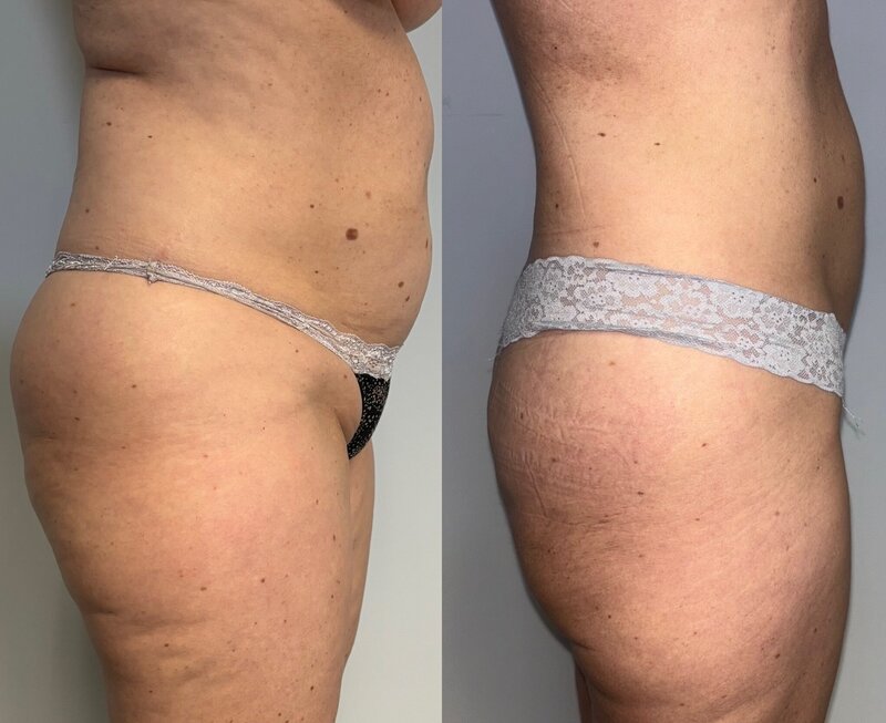 Before and after photos of Zula Modern Medspa stretch mark treatment patient