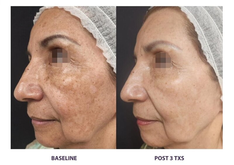 Before and after photos of Zula Modern Medspa discoloration treatment patient