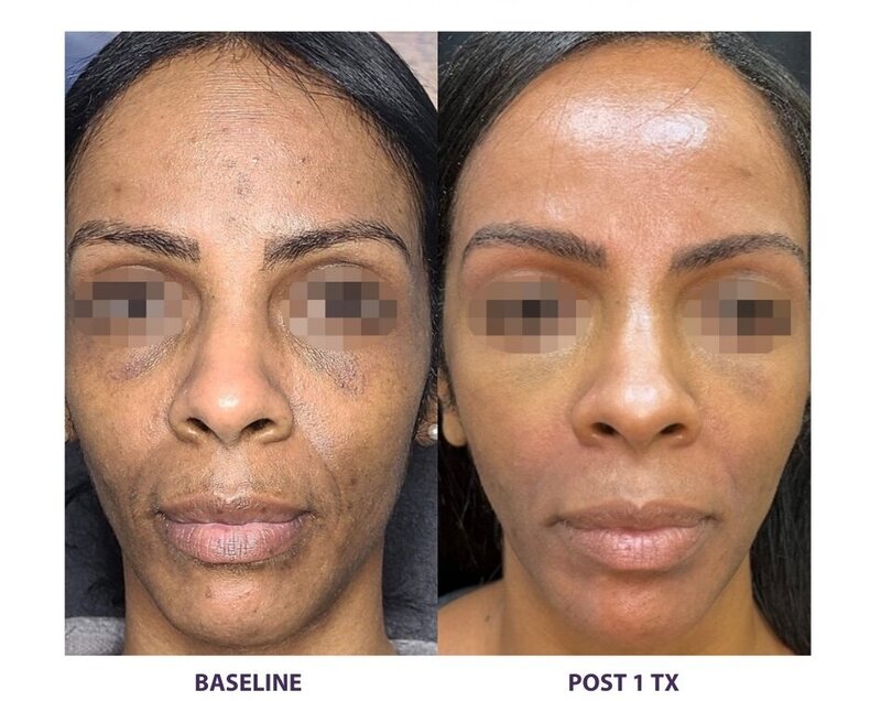 Before and after photos of Zula Modern Medspa anti-aging treatment patient
