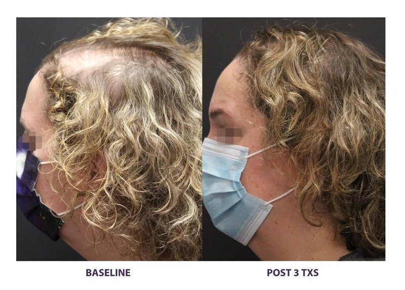 Before and after photos of Zula Modern Medspa hair thinning treatment patient