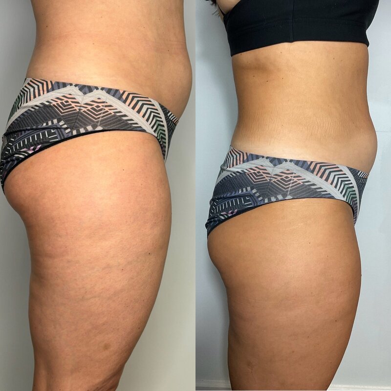 Before and after photos of Zula Modern Medspa fat loss treatment patient