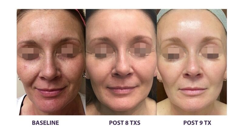 Before and after photos of Zula Modern Medspa hyperpigmentation treatment patient