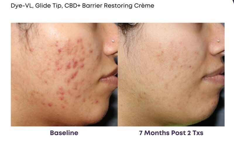 Before and after photos of Zula Modern Medspa discoloration treatment patient
