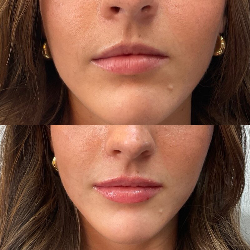 Before and after photos of Zula Modern Medspa volume loss treatment patient