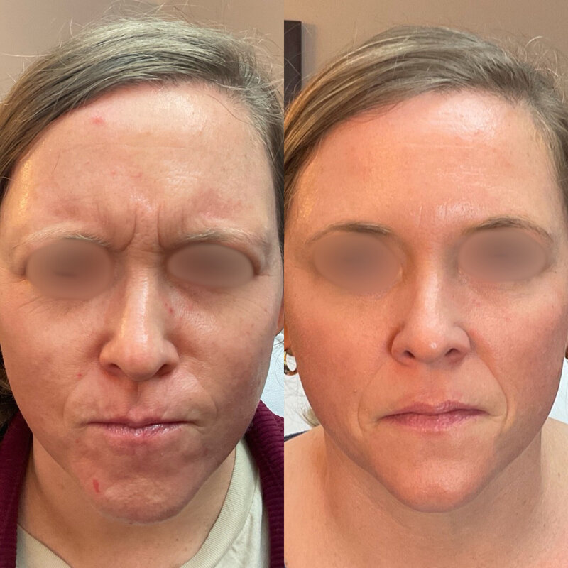 Before and after photos of Zula Modern Medspa botox treatment patient