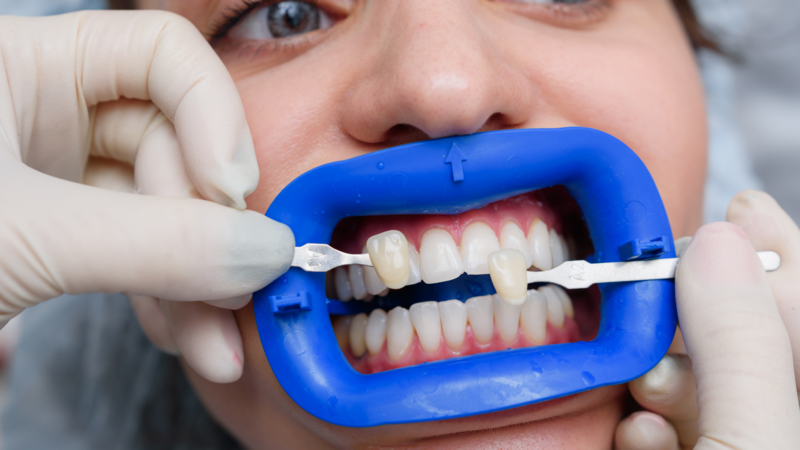 Dentist checking to make sure that veneers will match the patient's natural tooth color.