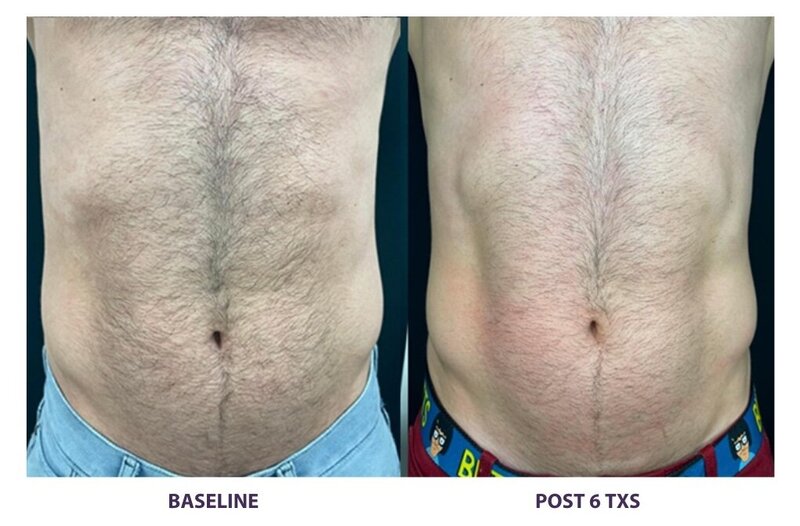 Before and after photos of Zula Modern Medspa fat loss treatment patient
