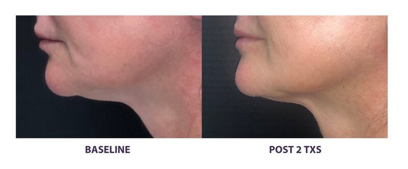 Before and after photos of Zula Modern Medspa double chin treatment patient