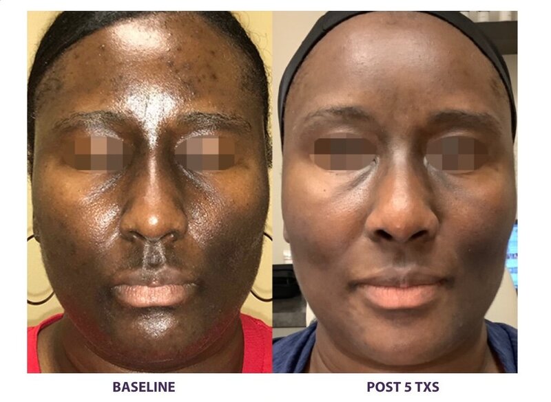 Before and after photos of Zula Modern Medspa hyperpigmentation treatment patient
