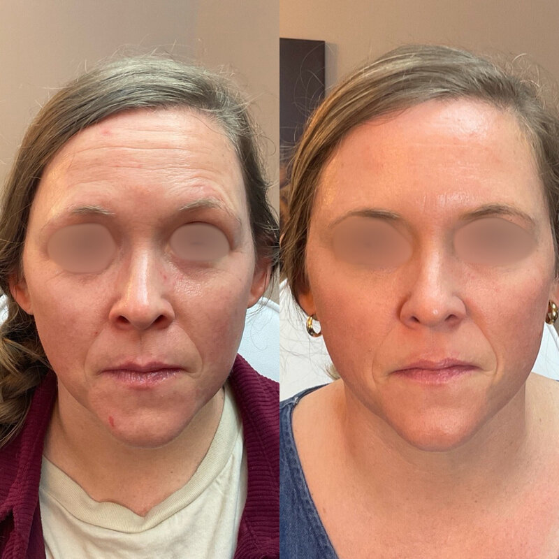 Before and after photos of Zula Modern Medspa wrinkle and fine line treatment patient