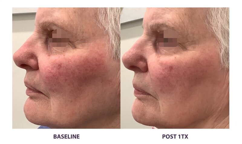 Before and after photos of Zula Modern Medspa rosacea treatment patient