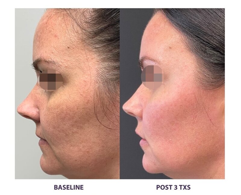 Before and after photos of Zula Modern Medspa anti-aging treatment patient