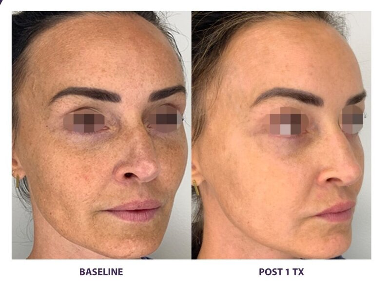 Before and after photos of Zula Modern Medspa anti-aging treatment patient