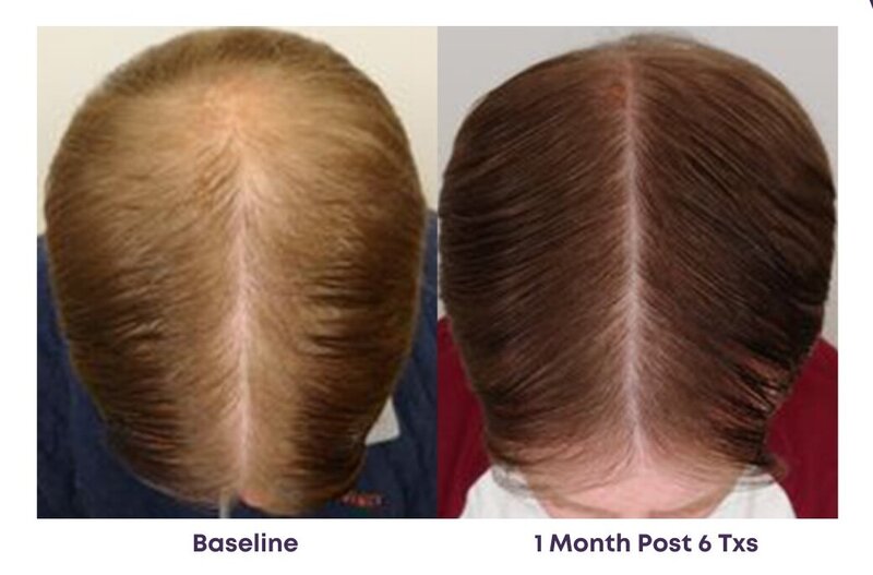 Before and after photos of Zula Modern Medspa hair thinning treatment patient