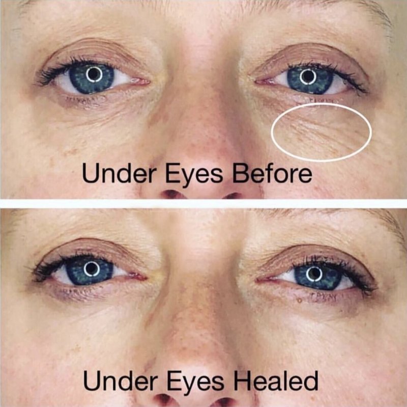undereyes