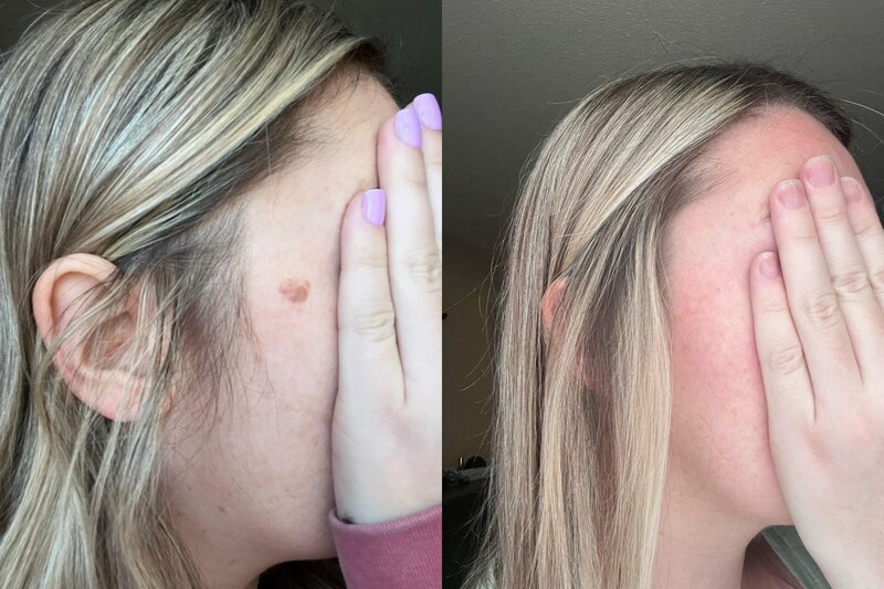 Before and after photos of Zula Modern Medspa discoloration treatment patient