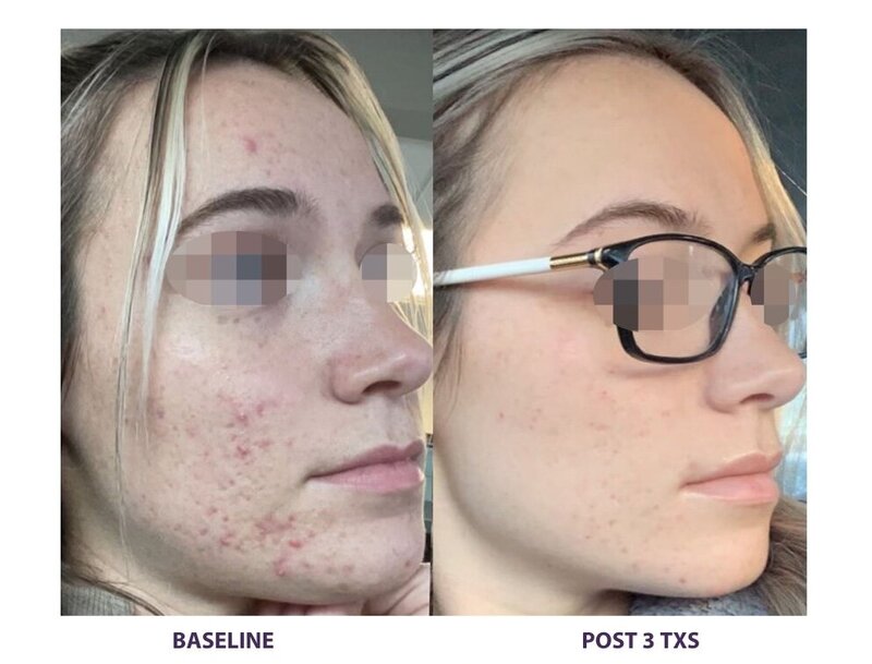 Before and after photos of Zula Modern Medspa pore texture treatment patient