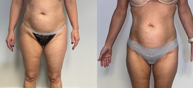 Before and after photos of Zula Modern Medspa stretch mark treatment patient