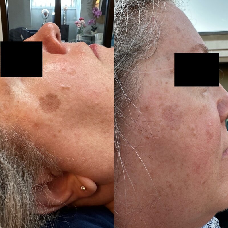 Before and after photos of Zula Modern Medspa discoloration treatment patient