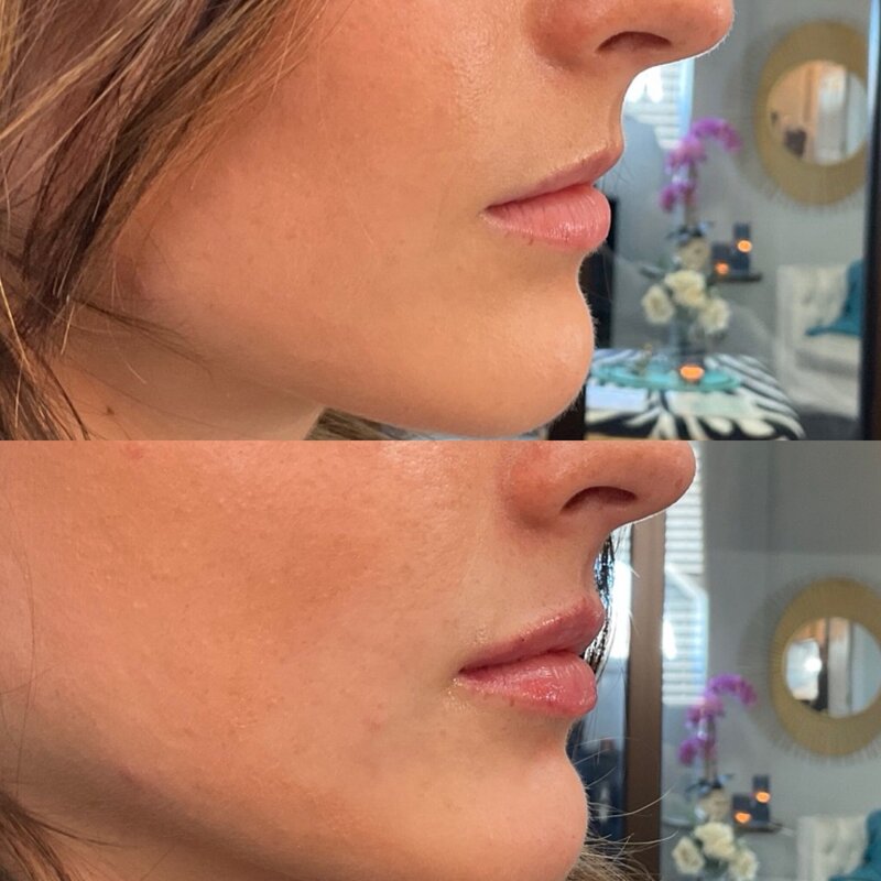 Before and after photos of Zula Modern Medspa volume loss treatment patient