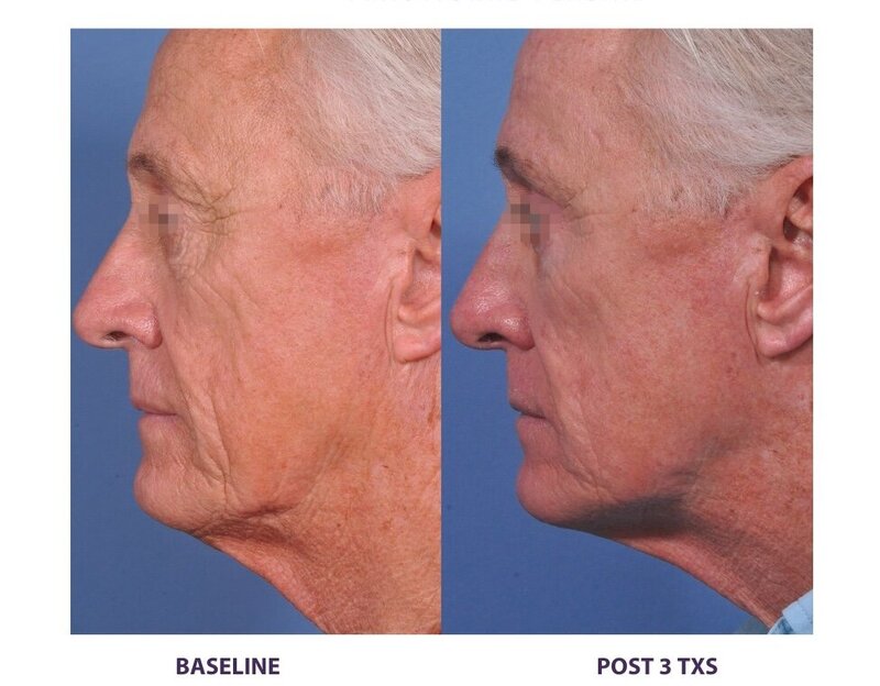 Before and after photos of Zula Modern Medspa wrinkle and fine line treatment patient