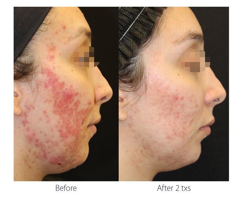 Before and after photos of Zula Modern Medspa pore texture treatment patient