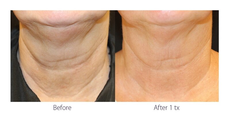 Before and after photos of Zula Modern Medspa anti-aging treatment patient