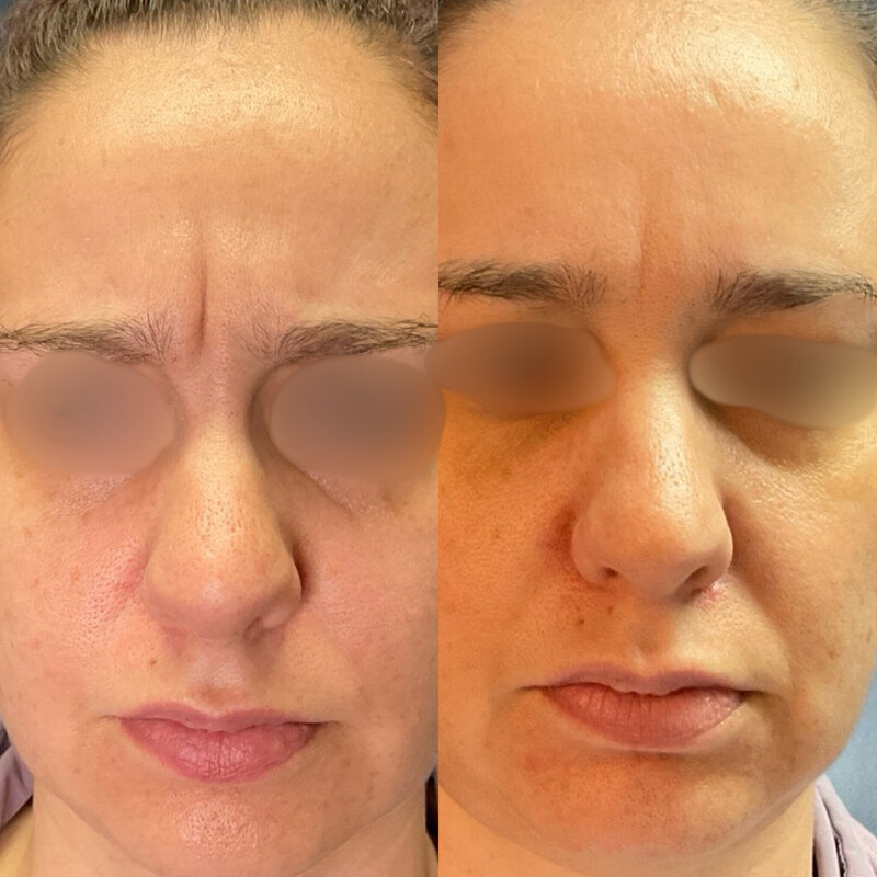 Before and after photos of Zula Modern Medspa botox treatment patient