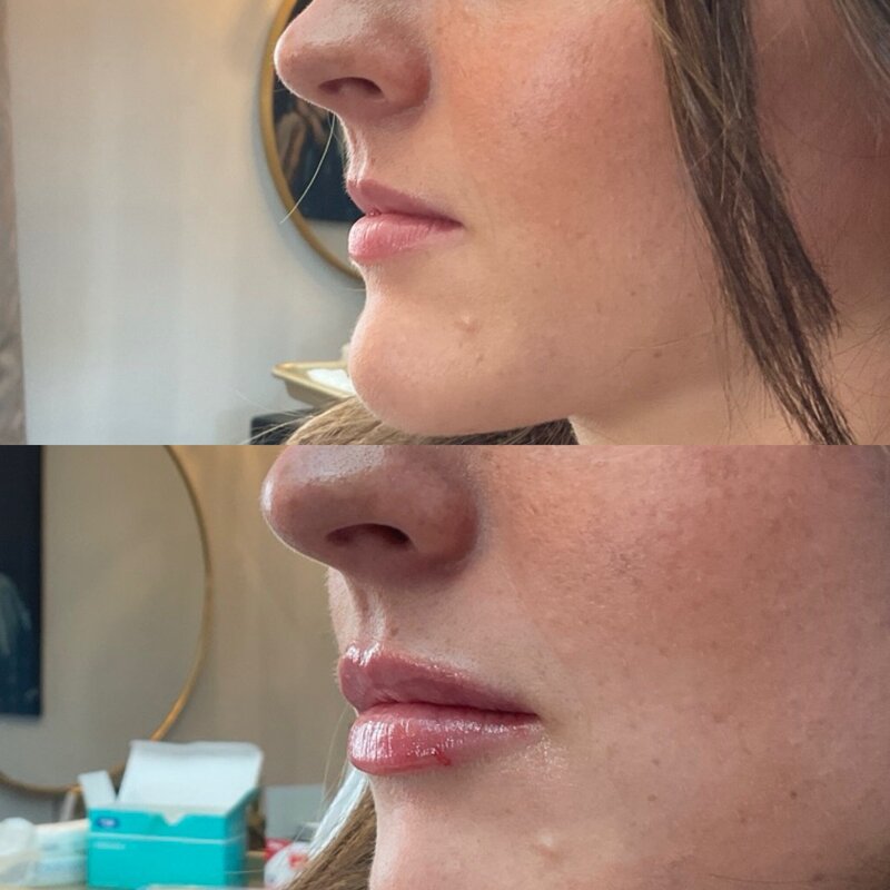 Before and after photos of Zula Modern Medspa volume loss treatment patient