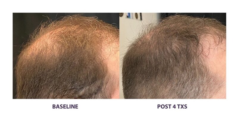 Before and after photos of Zula Modern Medspa hair thinning treatment patient