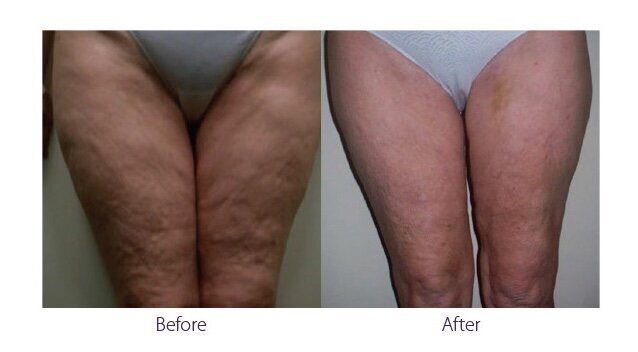 Before and after photos of Zula Modern Medspa anti-aging treatment patient