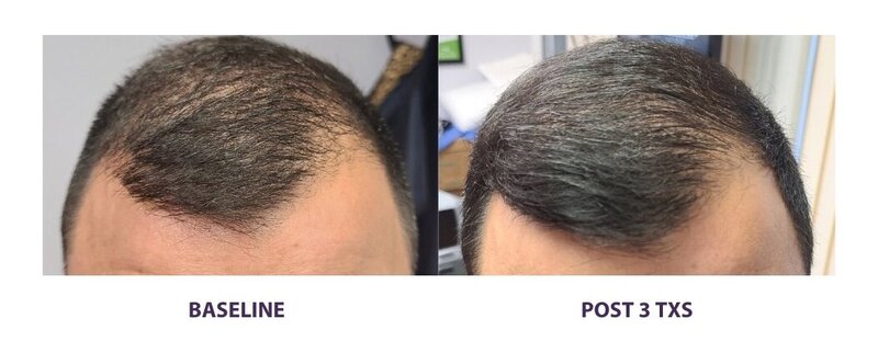 Before and after photos of Zula Modern Medspa hair thinning treatment patient
