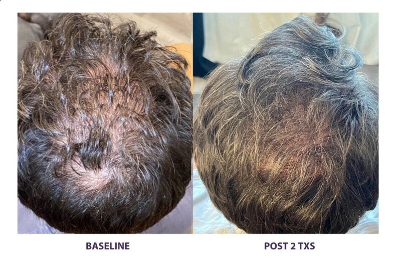 Before and after photos of Zula Modern Medspa hair thinning treatment patient