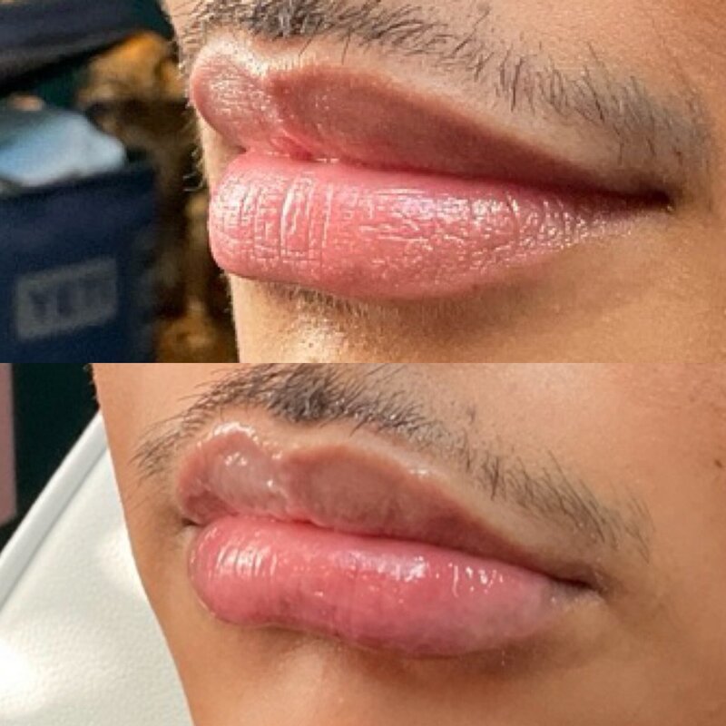 Before and after photos of Zula Modern Medspa volume loss treatment patient