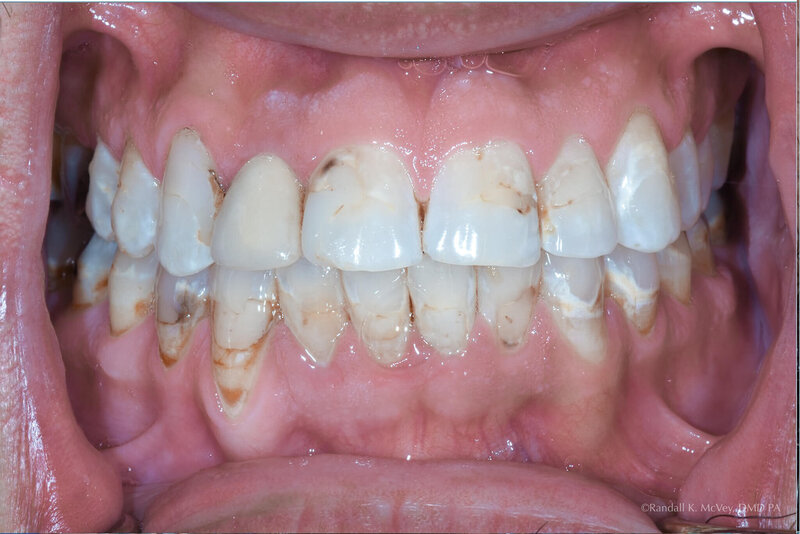 Example 1- a close up shot of the teeth  before  VENEERS & CROWNS