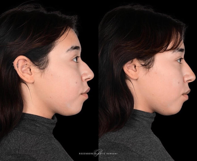 Nose Filler Results